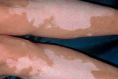 皮肤过敏可能诱发白癜风吗？